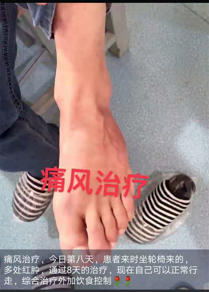 通风治疗，治疗前因疼痛只能坐轮椅，多处红肿，经过8天综合治疗+饮食控制，患者现在自己可下地正常行走，红肿消退，脚型恢复