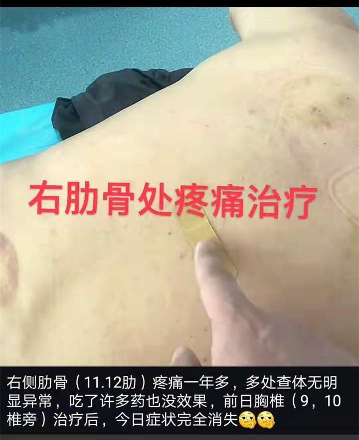 右侧肋骨（11、12）疼痛一年多，多处查体无明显异常，吃了许多药也没效果，前日胸椎（9、10椎旁）治疗后，今日症状完全消失，再也不疼了