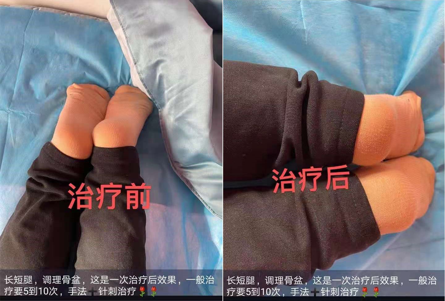 长短腿，调理骨盆，手法+针刺治疗，一般治疗需要5~10次。这是一次治疗后效果，长短腿明显改善