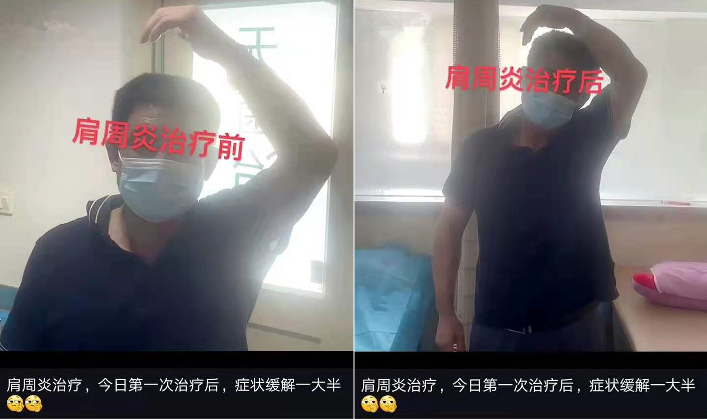 肩周炎治疗，治疗前手臂弯曲最多放置头顶，且疼痛不已。第一次治疗后，症状缓解一大半，手臂能比较轻松的勾到另一侧的耳朵