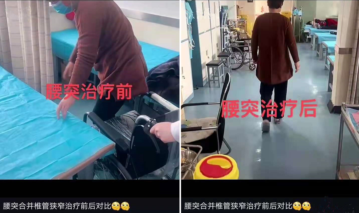 腰突治疗前，只能坐轮椅出行，身体无法直立，疼痛；腰突合并椎管狭窄治疗后，疼痛基本消失，直立行走，脚步轻松