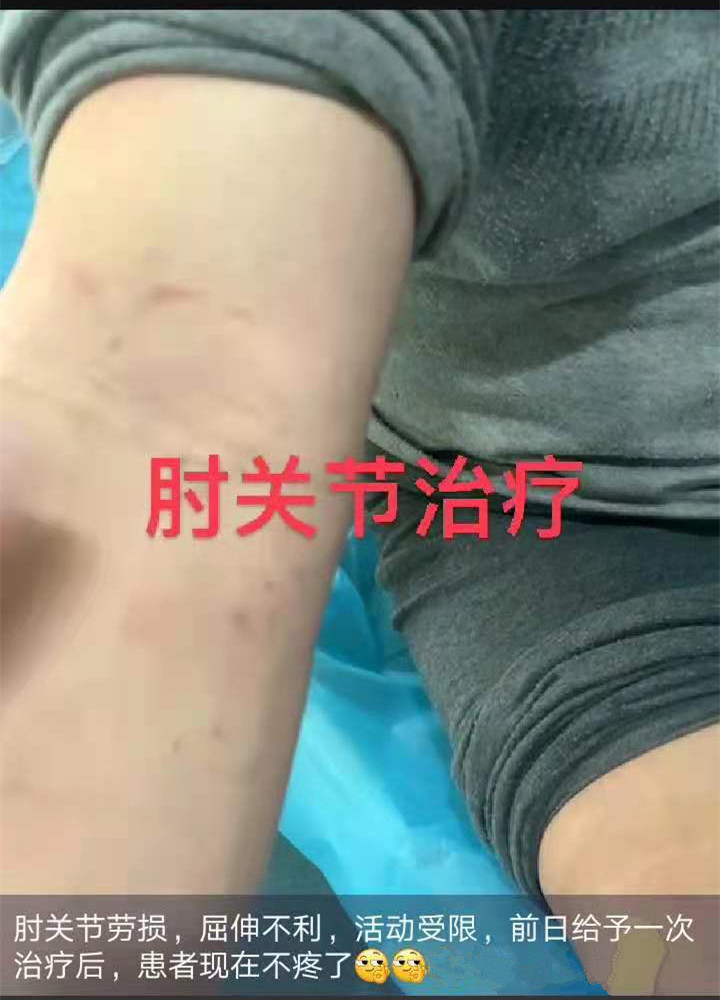 案例四_肘关节劳损