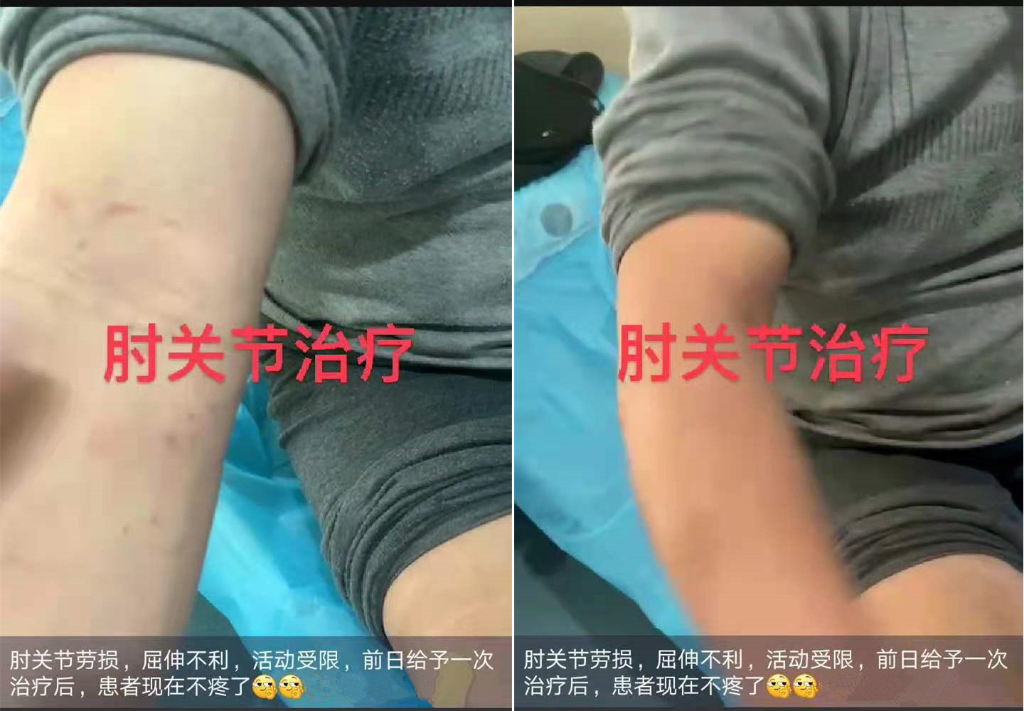 肘关节劳损，治疗前屈伸不利，活动受限；给予一次针刀治疗后，不但疼痛消失，且肘部屈伸改善很多