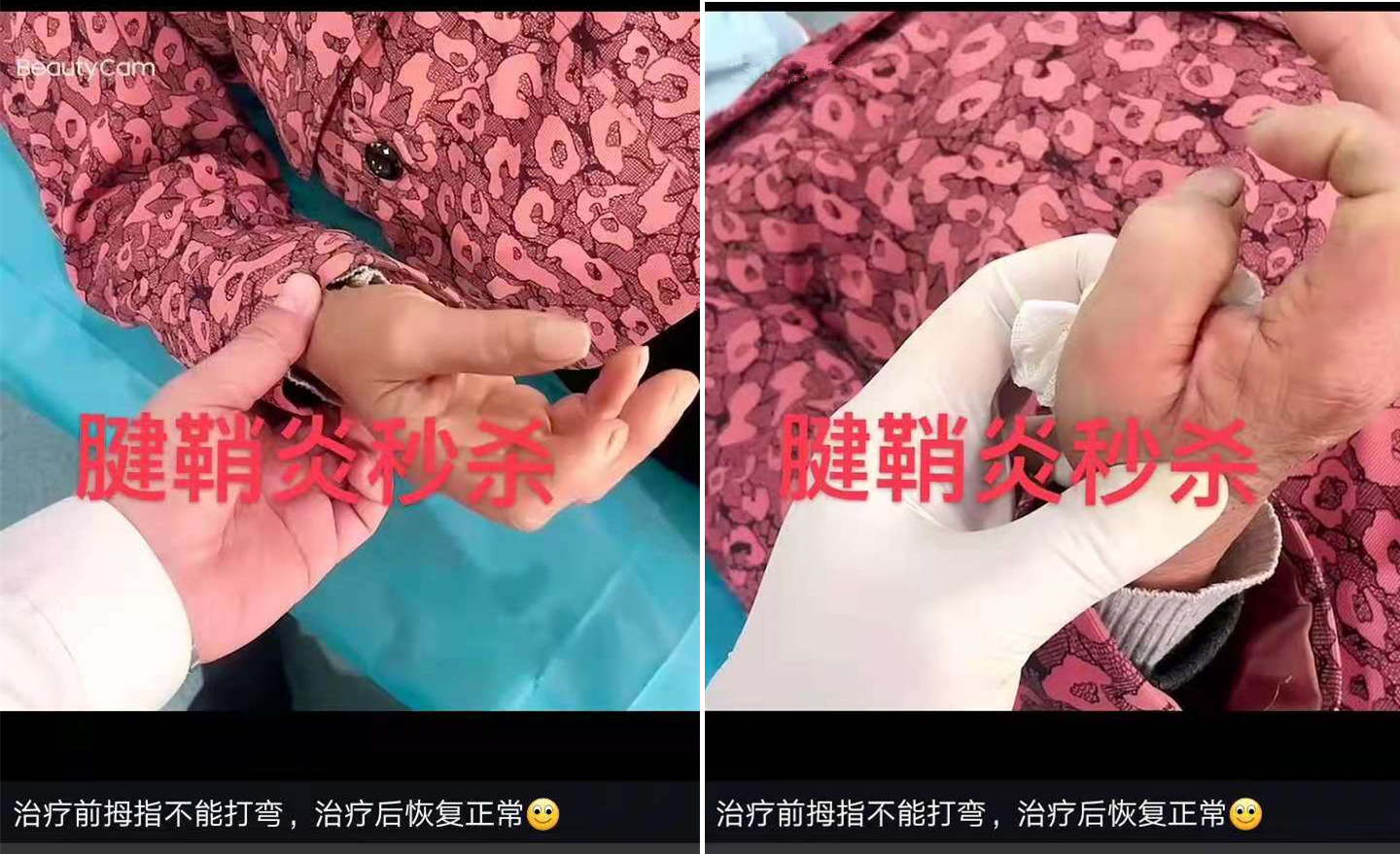 腱鞘炎，治疗前拇指不能打弯，给生活造成诸多不便，一次治疗后即恢复正常，屈指打弯轻松自如
