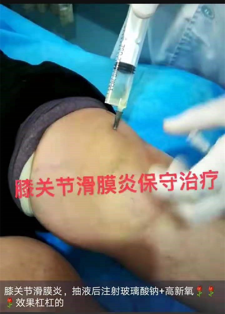 案例六_膝关节滑膜炎