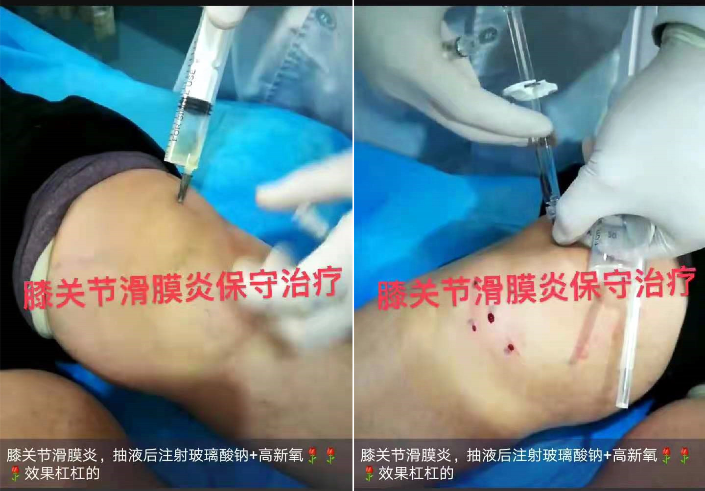 膝关节滑膜炎，治疗前膝盖处肿胀膨大，疼痛；抽液后注射玻璃+高新氧治疗后，肿胀消退，疼痛缓解