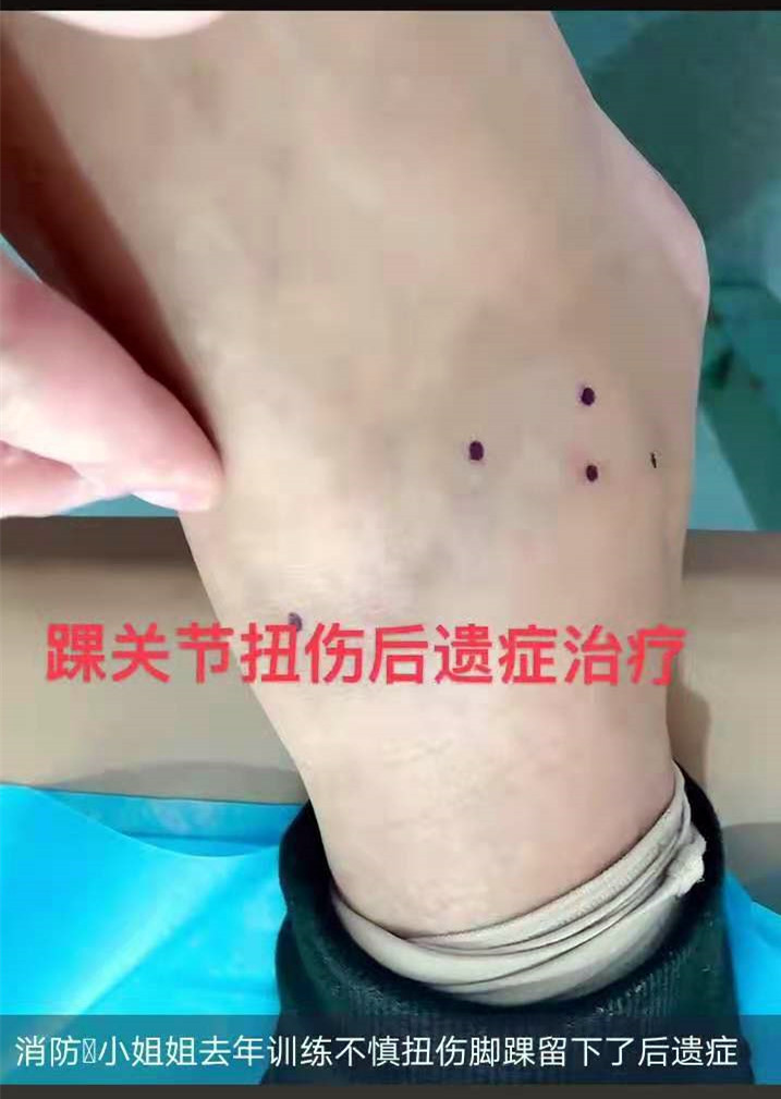 去年训练不慎扭伤，脚踝留下后遗症，脚踝总是肿肿的，酸胀，尤其是长时间走路以后会觉得很不适。针刀治疗后，症状好转，基本恢复正常