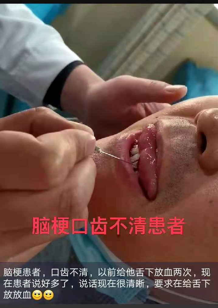 脑梗患者，口齿不清，舌下放血两次后，患者自述有很大改善，说话现在很清晰